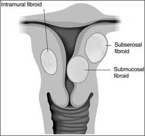 Fibroids vs Polyps 