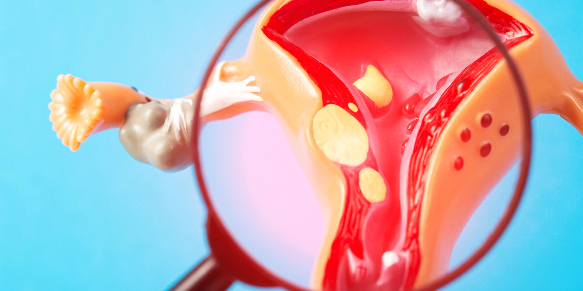 An anatomical model illustrating uterine fibroids